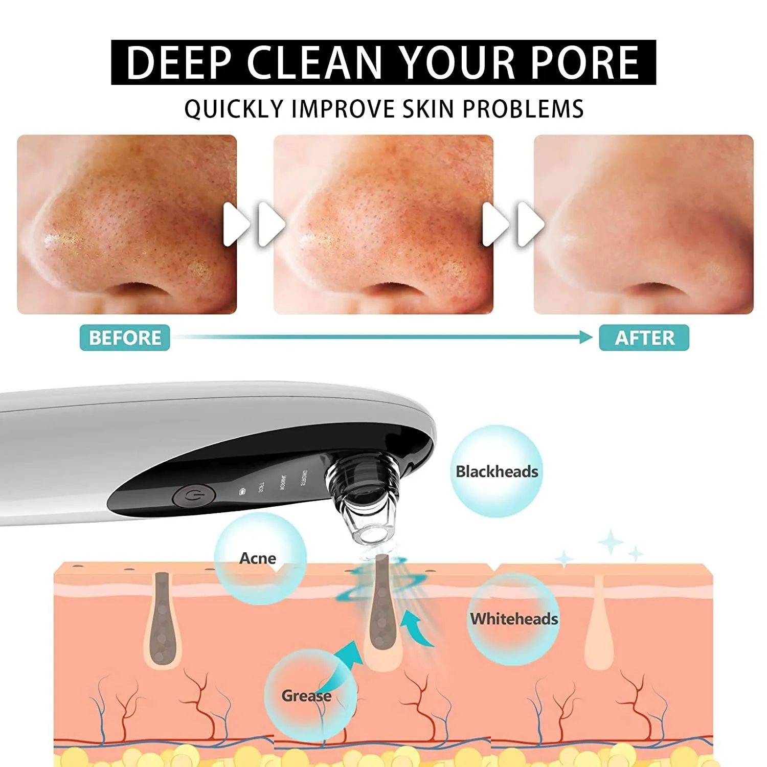 Blackhead Remover Vacuum with WiFi Camera, x10 Zoom Microscope Facial Tools with 3 Blackhead Sucker, Electric Blackhead Remover